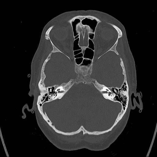 Cerebral venous infarction with hemorrhage (Radiopaedia 65343-74381 Axial bone window 28).jpg