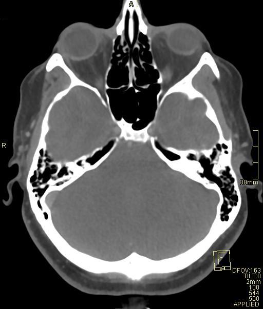 Cerebral venous sinus thrombosis (Radiopaedia 91329-108965 Axial venogram 25).jpg