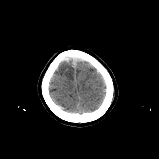 Cerebral venous throbmosis - hemorrhagic venous infarction (Radiopaedia 87318-103613 Axial non-contrast 156).jpg