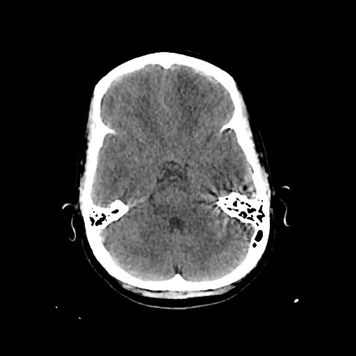 File:Cerebral venous throbmosis - hemorrhagic venous infarction (Radiopaedia 87318-103613 Axial non-contrast 50).jpg