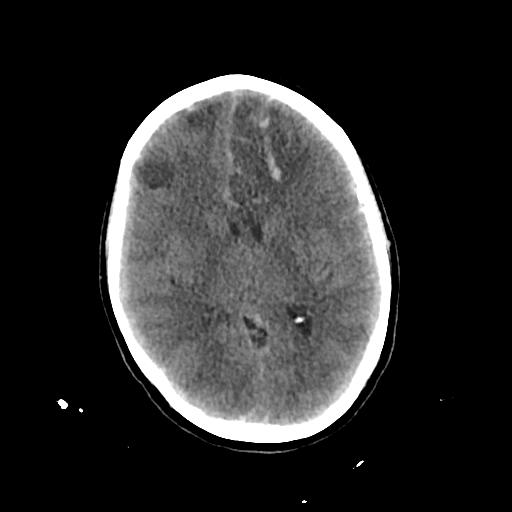 Cerebral venous throbmosis - hemorrhagic venous infarction (Radiopaedia 87318-103613 Axial non-contrast 89).jpg