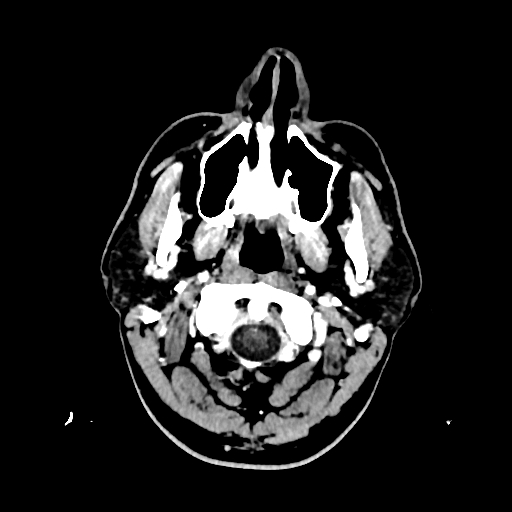 File:Cerebral venous thrombosis (CVT) (Radiopaedia 77524-89685 Axial with contrast 1).jpg