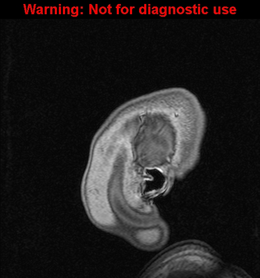 File:Cerebral venous thrombosis (Radiopaedia 37224-39208 Sagittal T1 C+ 4).jpg