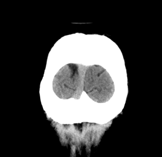 File:Cerebral venous thrombosis (Radiopaedia 38392-40467 Coronal non-contrast 35).png