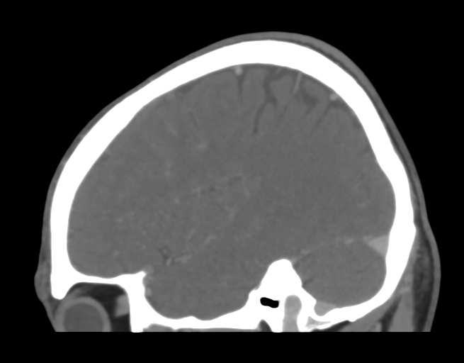 File:Cerebral venous thrombosis (Radiopaedia 38392-40467 D 14).png