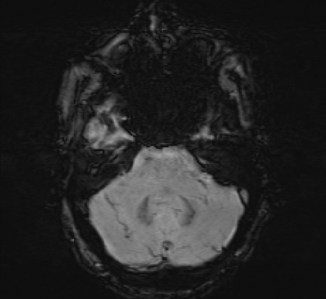 Cerebral venous thrombosis (Radiopaedia 71207-81504 Axial SWI 10).jpg