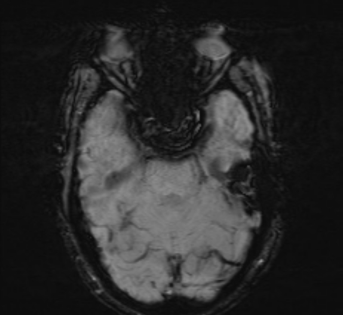 Cerebral venous thrombosis (Radiopaedia 71207-81504 Axial SWI 15).jpg