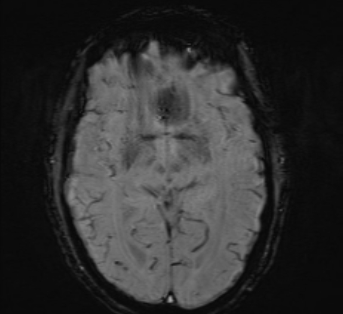 Cerebral venous thrombosis (Radiopaedia 71207-81504 Axial SWI 24).jpg
