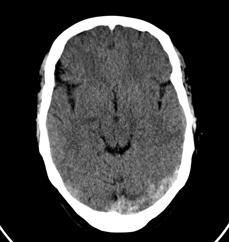 Cerebral venous thrombosis - CT only (Radiopaedia 41031-43778 Axial non-contrast 52).jpg