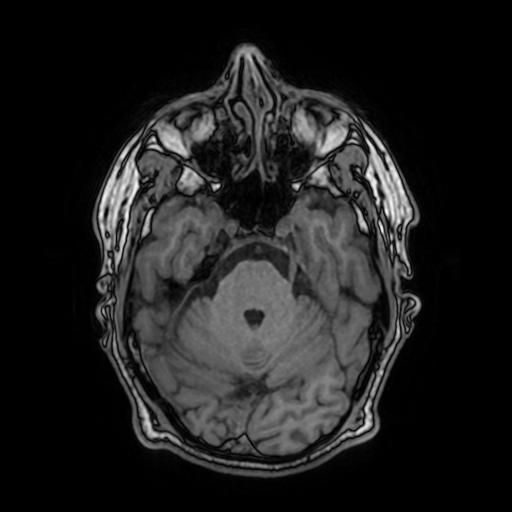 File:Cerebral venous thrombosis with secondary intracranial hypertension (Radiopaedia 89842-106957 Axial T1 63).jpg