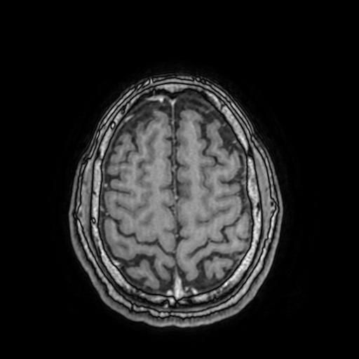 File:Cerebral venous thrombosis with secondary intracranial hypertension (Radiopaedia 89842-106957 Axial T1 C+ 137).jpg