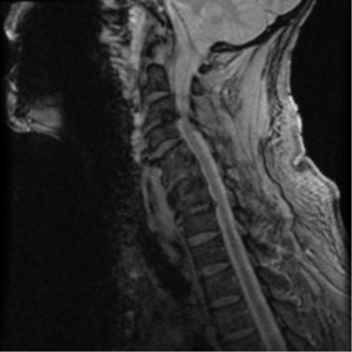 File:Cervical canal stenosis with cord compression (Radiopaedia 34114-35374 D 11).png