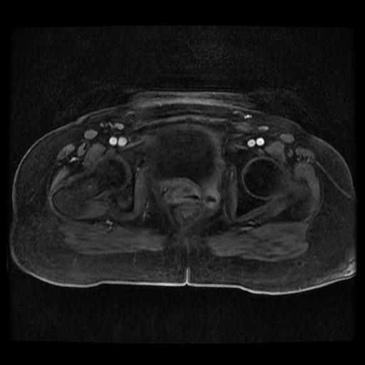 File:Cervical carcinoma (Radiopaedia 70924-81132 Axial T1 C+ fat sat 125).jpg