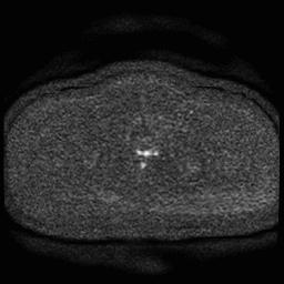 File:Cervical carcinoma (Radiopaedia 85405-101028 Axial DWI 63).jpg