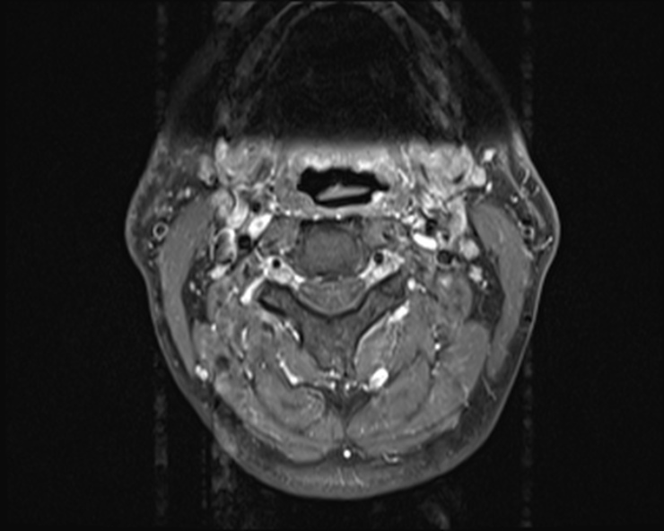 File:Cervical disc extrusion (Radiopaedia 53950-60077 Axial T1 C+ fat sat 3).jpg