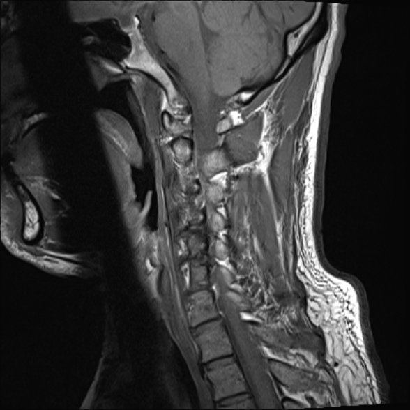 File:Cervical disc extrusion (Radiopaedia 53950-60077 Sagittal T1 12).jpg