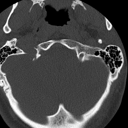 Cervical schwannoma (Radiopaedia 57979-64974 Axial bone window 7).png
