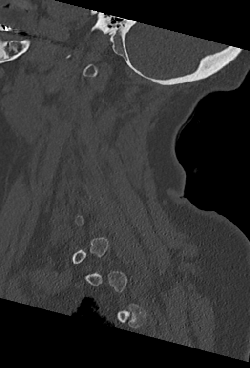 Cervical spine ACDF loosening (Radiopaedia 48998-54070 Sagittal bone window 65).png