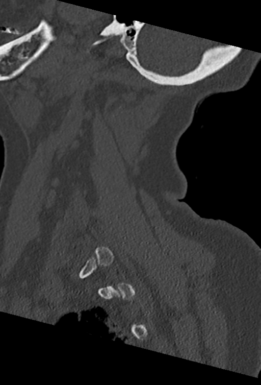 Cervical spine ACDF loosening (Radiopaedia 48998-54070 Sagittal bone window 69).png