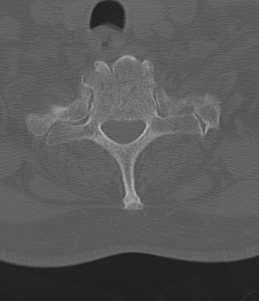 File:Cervical spine fracture in the setting of ankylosis (Radiopaedia 37038-38715 Axial bone window 50).png