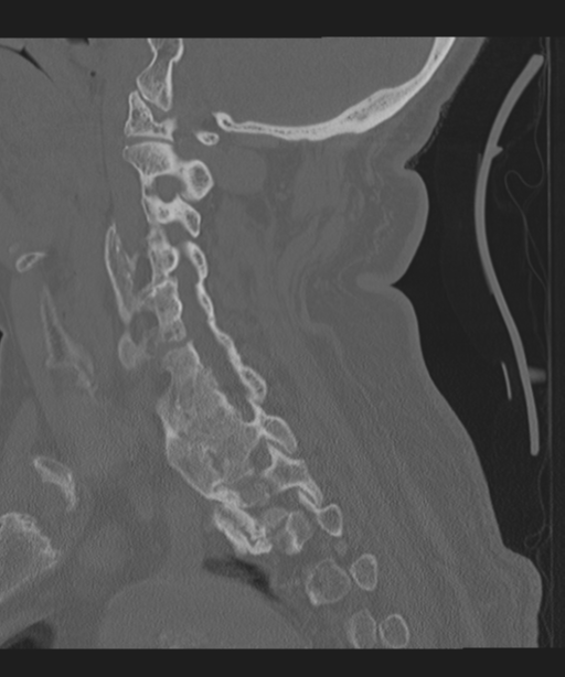 Cervical spine fracture in the setting of ankylosis (Radiopaedia 37038-38715 Sagittal bone window 32).png