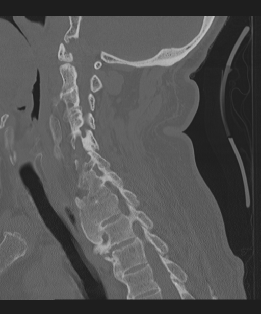 Cervical spine fracture in the setting of ankylosis (Radiopaedia 37038-38715 Sagittal bone window 47).png