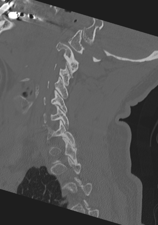 Cervical spine fractures with vertebral artery dissection (Radiopaedia 53296-59268 Sagittal bone window 46).png