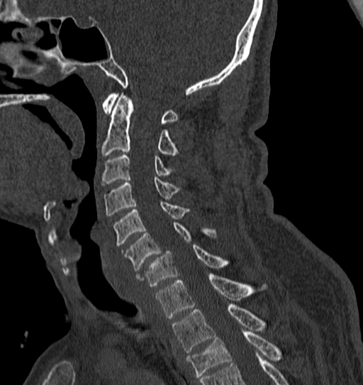 Cervical spine trauma with tear drop fracture and perched facet joint (Radiopaedia 53989-60127 Sagittal bone window 84).jpg