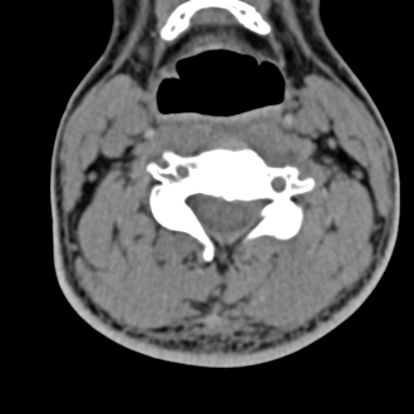Cervical spondylodiscitis (Radiopaedia 28057-29489 Axial non-contrast 40).jpg