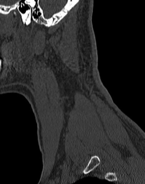File:Cervical spondylodiscitis (Radiopaedia 28057-29489 Sagittal bone window 9).jpg