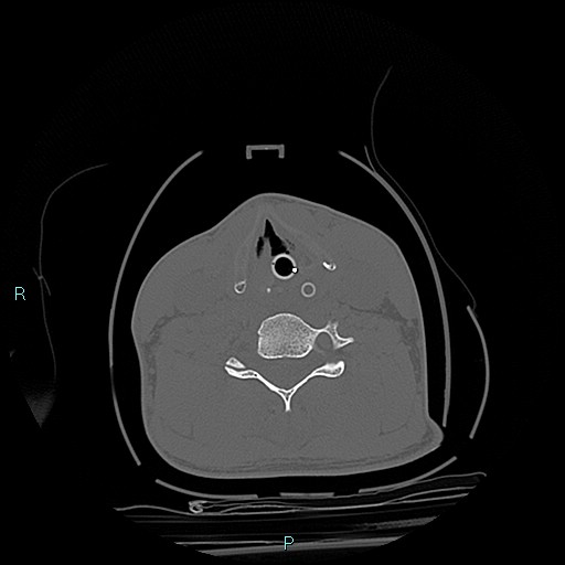 File:Cervical vertebral burst fracture (Radiopaedia 37420-39258 Axial bone window 1).jpg