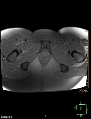 File:Cesarian scar endometriosis (Radiopaedia 68495-78066 Axial T1 fat sat 25).jpg
