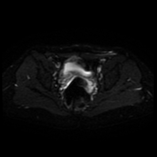 File:Cesarian section scar endometriosis (Radiopaedia 66520-75799 Axial DWI 14).jpg
