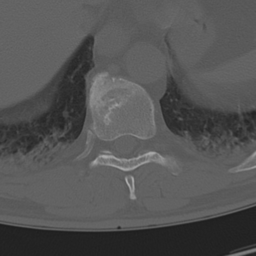 Chance fracture (Radiopaedia 33854-35020 Axial bone window 64).png