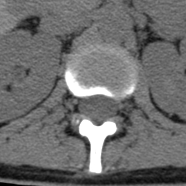 File:Chance fracture (Radiopaedia 36521-38081 Axial non-contrast 73).jpg