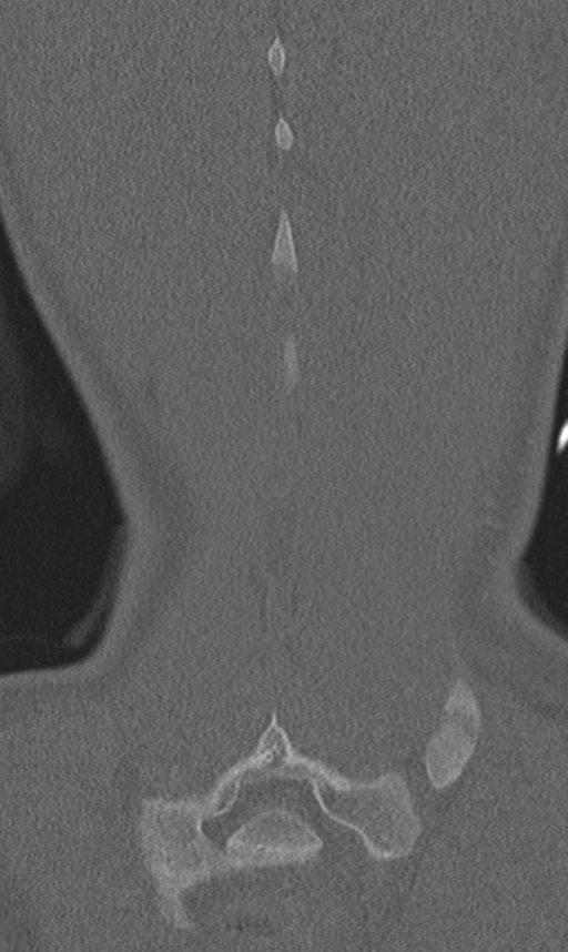 Chance fracture (Radiopaedia 40360-42912 Coronal bone window 65).png