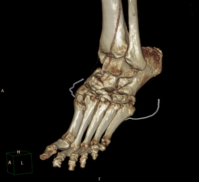 File:Charcot joint (Radiopaedia 36629-38194 3D bone window 1).jpg