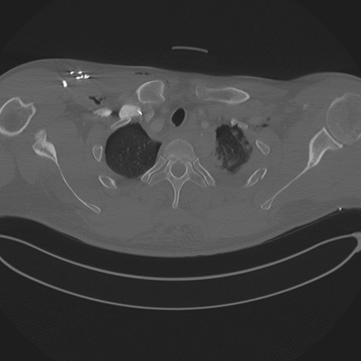 Chest multitrauma - aortic injury (Radiopaedia 34708-36147 Axial bone window 42).png