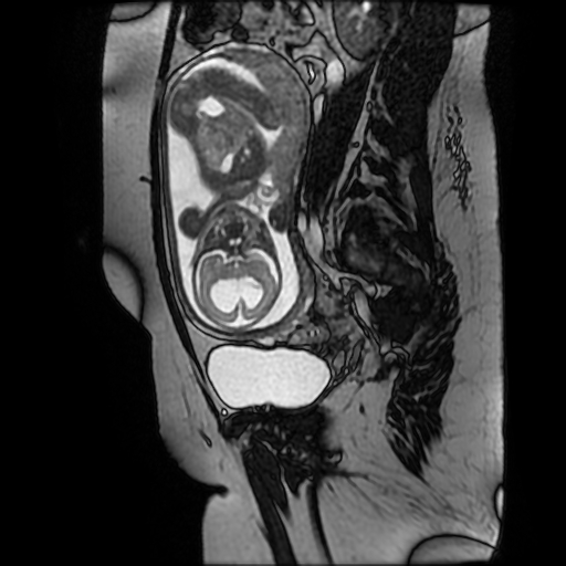 File:Chiari II malformation - fetal MRI (Radiopaedia 68099-77581 Sagittal Fiesta 21).jpg
