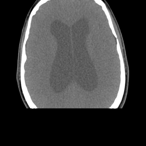 Chiari I malformation and obstructive hydrocephalus (Radiopaedia 41185-43981 D 4).png