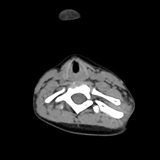 Chiari I with syrinx and skull base anomalies (Radiopaedia 89444-106412 Axial non-contrast 106).jpg