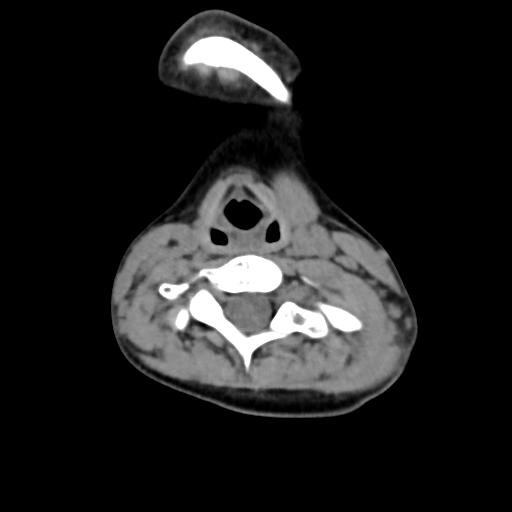 Chiari I with syrinx and skull base anomalies (Radiopaedia 89444-106412 Axial non-contrast 98).jpg