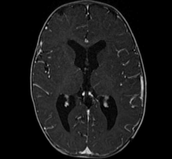 Chiasmatic-hypothalamic glioma (Radiopaedia 90079-107252 Axial T1 C+ 46).jpg
