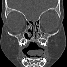 Choanal atresia (Radiopaedia 88525-105975 Coronal bone window 19).jpg