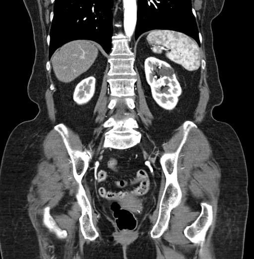 File:Cholecystoduodenal fistula due to calculous cholecystitis with gallstone migration (Radiopaedia 86875-103077 B 32).jpg