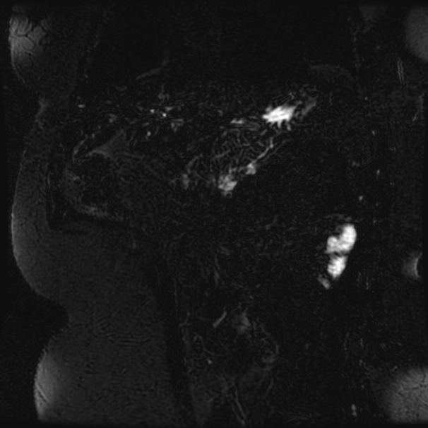 Choledocholithiasis on CT and MRI (Radiopaedia 24825-25088 Coronal T2 86).jpg