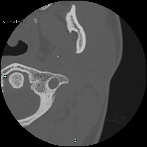 Cholesterol granuloma of the petrous apex (Radiopaedia 64358-73141 Axial bone window 105).jpg