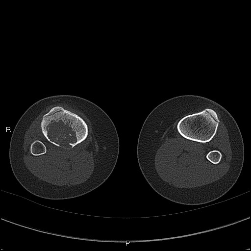 File:Chondroblastoma (Radiopaedia 62721-71030 Axial bone window 82).jpg