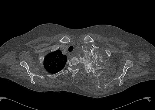 File:Chondrosarcoma - chest wall (Radiopaedia 65192-74199 Axial bone window 22).jpg