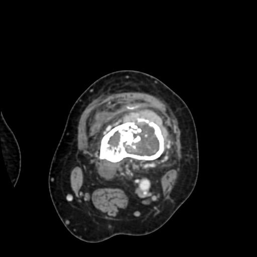 Chondrosarcoma - femur (Radiopaedia 64187-72954 Axial with contrast 33).jpg